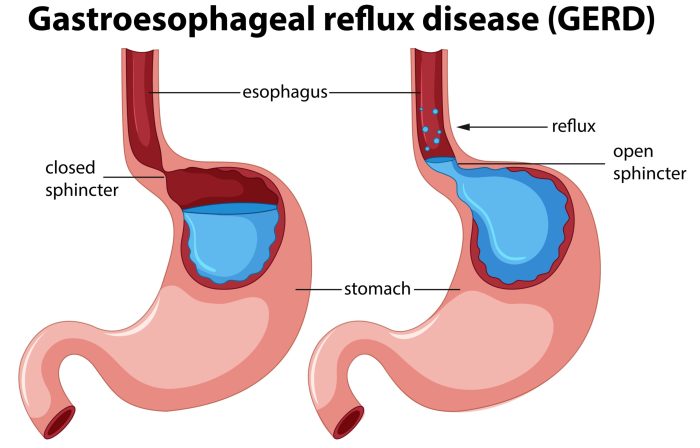 Reflux gastroesophageal gerd